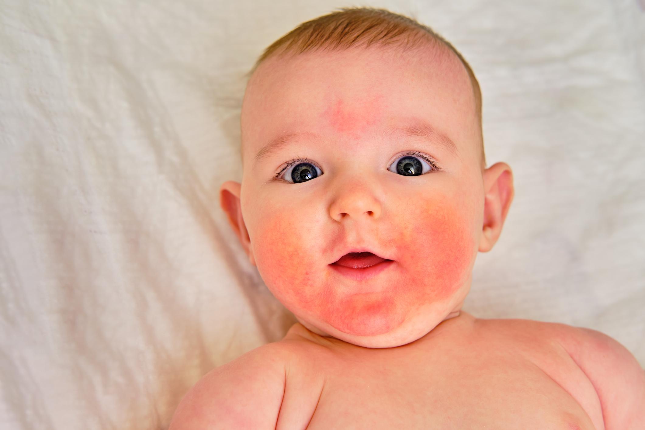 Parvovirus